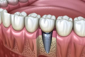 Unlock Your Best Smile with Removable or Fixed Dental Implants