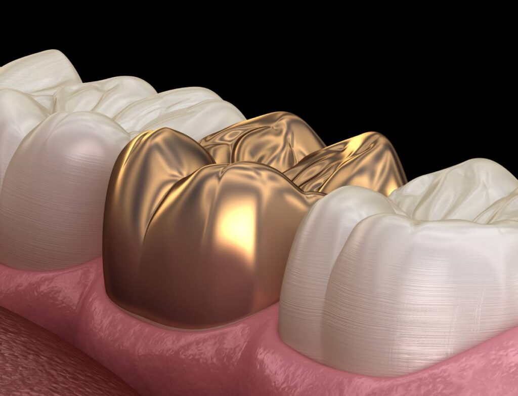 Gold Crowns: Timeless Durability and Style for Your Teeth